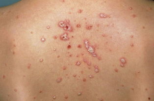 湿疹 牛皮癣怎么辨识 别傻了 一勺鸡蛋清让你搞定多年皮肤病