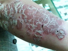 牛皮癣的发病原因