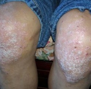 男人牛皮癣护理相关介绍