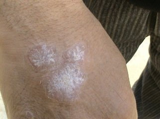 银屑病治疗后的图片