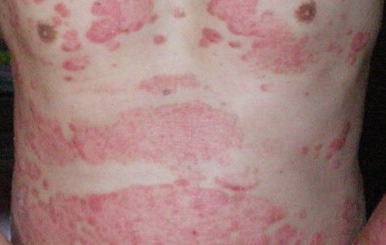 男性红皮病型牛皮癣表现