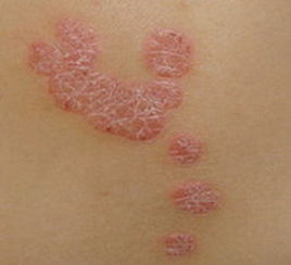 治疗牛皮癣吃什么东西比较好