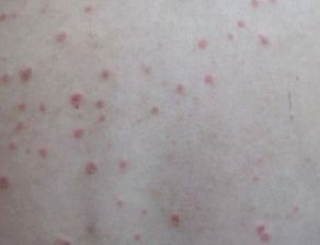 牛皮癣发作前兆是什么