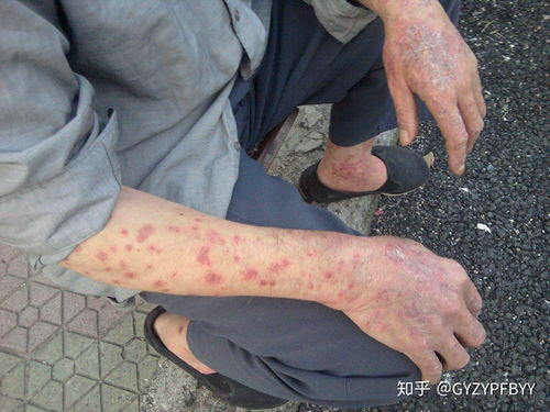 牛皮癣怎么护理,贵阳看牛皮癣的医院在哪里