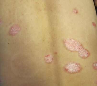 中年脓疱型牛皮癣手术治疗