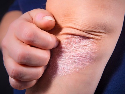 牛皮癣的饮食禁忌