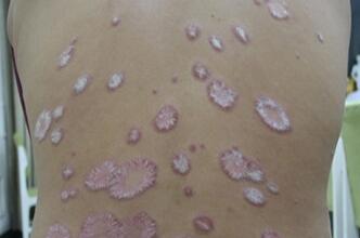 寻常型银屑病病因