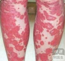 牛皮癣的饮食要注意什么