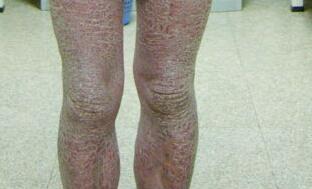 关节型牛皮癣症状