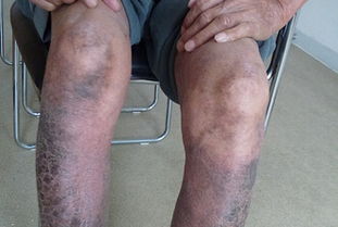 儿童关节病型银屑病诊断