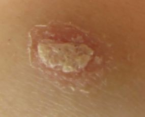 如何选择治牛皮癣的医院