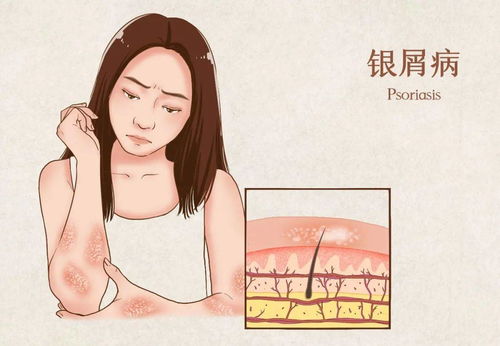 饮食清淡 全吃素 银屑病患者到底该如何饮食