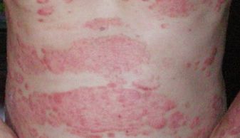 中年红皮病型牛皮癣寿命