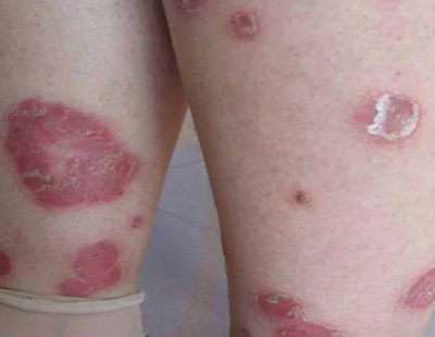 身患牛皮癣,该注意什么避免复发?