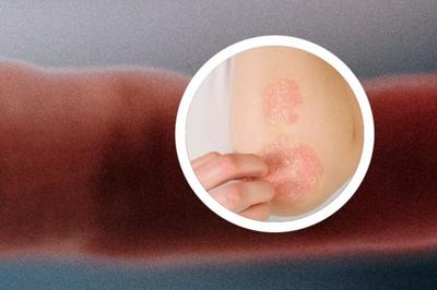 银屑病哺乳会传染吗