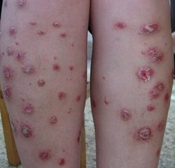 少年银屑病寿命会有影响吗