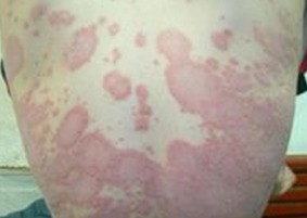 男性红皮病型银屑病物理治疗