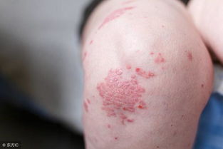 正确认识银屑病,避免步入下面五个误区