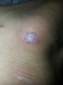 请问这是牛皮癣嘛