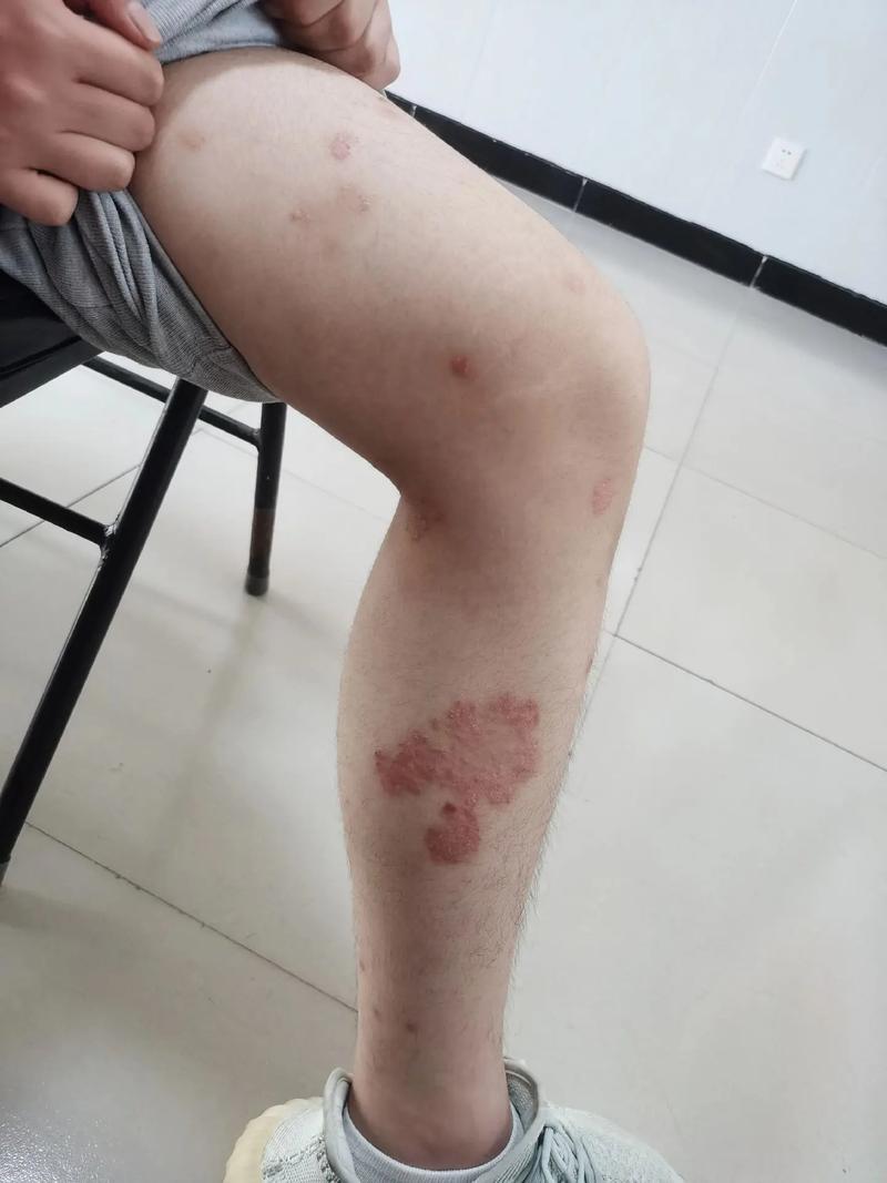 寻常性银屑病(牛皮癣)