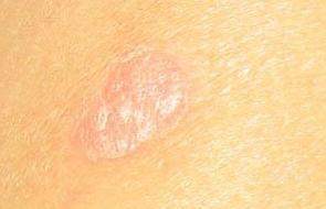 季节性牛皮癣复发前一般都会出现哪些症状表现呢