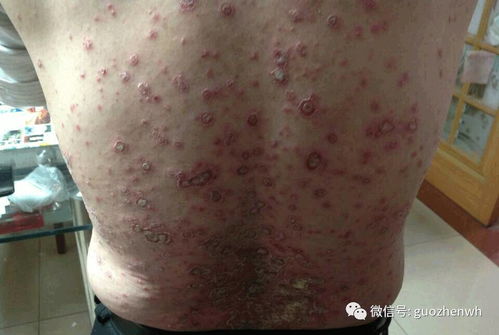 国珍产品调理好了老爸26年牛皮癣,食道静脉曲张等疾病,感恩国珍