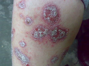 经典图片 银屑病