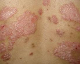 银屑病治疗要注意哪几点