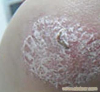 唐山牛皮癣就医需要注意的四项原则_唐山牛皮癣就医需要注意的四项原则高清大图_唐山牛皮癣就医需要注意的四项原则高清图片_一比多产品库