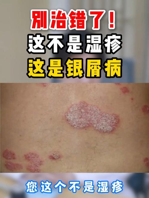 别治错了!这不是湿疹 这是银屑病