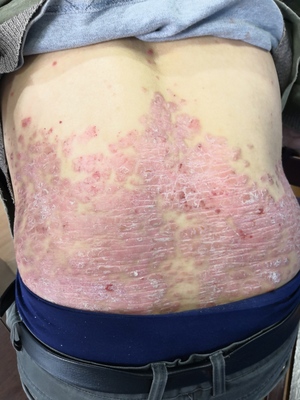 银屑病牛皮癣是“辛苦”出来的