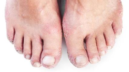 银屑病的临床表现及类型