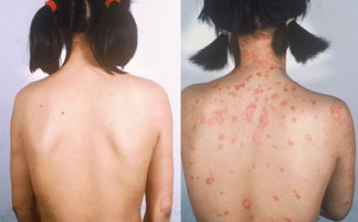 牛皮癣早期会有哪些症状