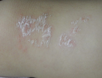 醋泡大蒜能治牛皮癣吗？科学解读与理性建议