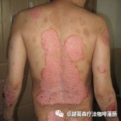 牛皮癣患者的福音 新希望与科学进展