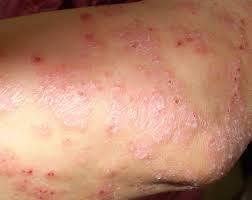 血虚型牛皮癣的成因、症状与中医治疗调理