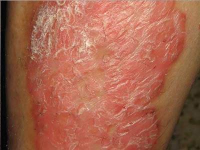 银屑病（牛皮癣）的常见症状