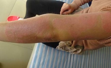 情绪伤害对牛皮癣的影响 潜移默化的身心关联