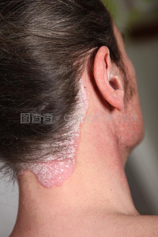 严重牛皮癣对颈部与耳内的影响及应对措施