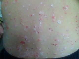 牛皮癣复发的治疗策略与应对方法