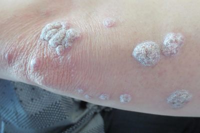 牛皮癣早期症状详解 识别早期信号，科学应对