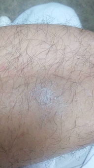 关于牛皮癣的基本介绍