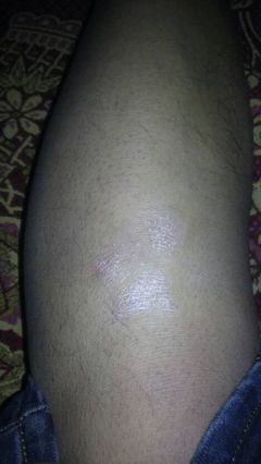 牛皮癣与军校报考 正确认知与应对之道