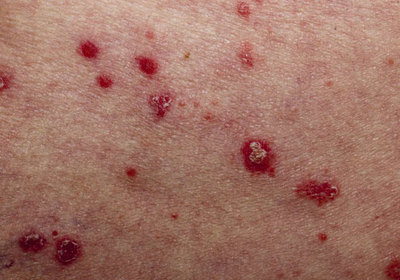 银屑病点状出血的原因及治疗方法详解