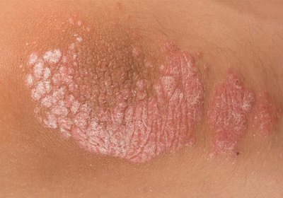 牛皮癣的类型及其临床表现图片指南