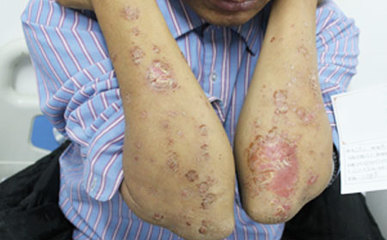 银屑病春发高峰将至，防治要有效及时