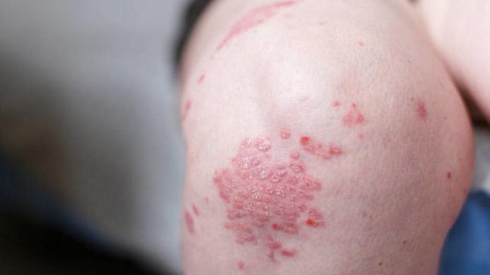 关于银屑病（牛皮癣）的3个真相！破除误解，科学治疗