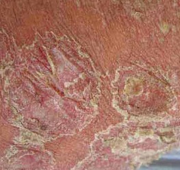 老年脓疱型牛皮癣的中医用药探析