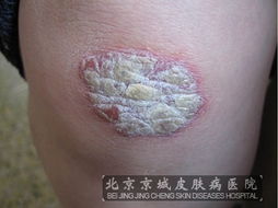 牛皮癣的病因与治疗 从成因到北京专科医院的建议
