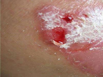 银屑病（牛皮癣）的常见症状与识别